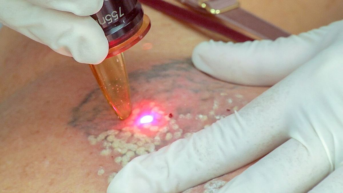 Ilustrație: tratament cu laser pentru îndepărtarea unui tatuaj pe pielea unei femei.